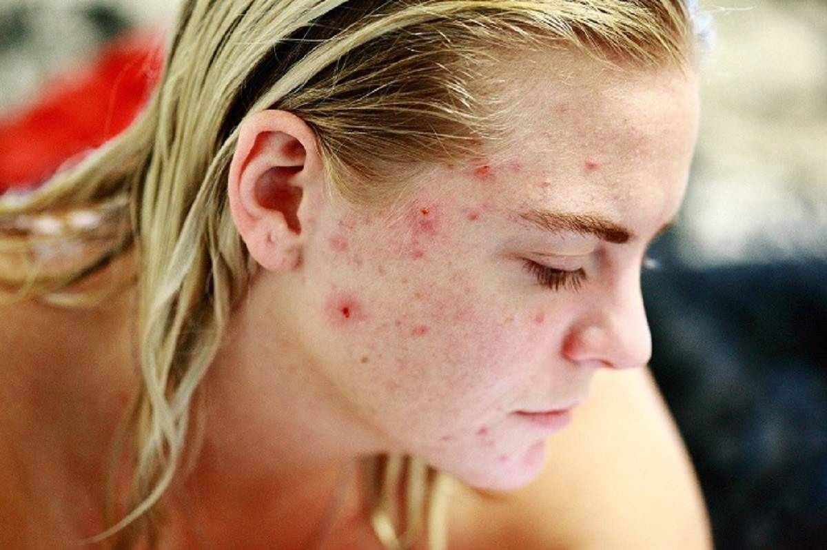 Acne: come prevenirlo