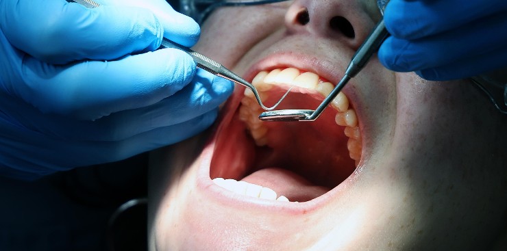 lavarsi maniera giusta evita dentista 